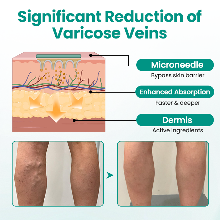 LBMLBM™ LegRenew Varicose Veins Patch