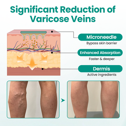 LBMLBM™ LegRenew Varicose Veins Patch