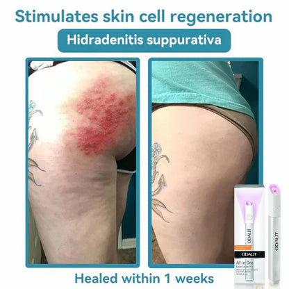 All-in-One CO₂ Laser Eraser Pen | Removes Moles, Warts, Skin Flaws & Pigmentation