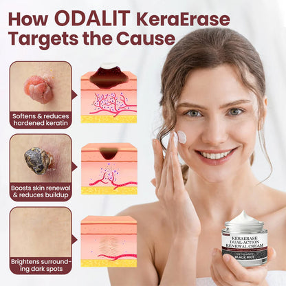 ODALIT™KeraErase Dual-Action Renewal Cream